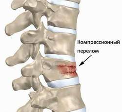 Реабилитация после компрессионного перелома позвоночника - Медицинский центр Бубновский